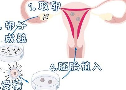 成都试管婴儿医院哪家强？详细选择建议及收费标准详细解析